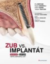 Zub vs. implantát